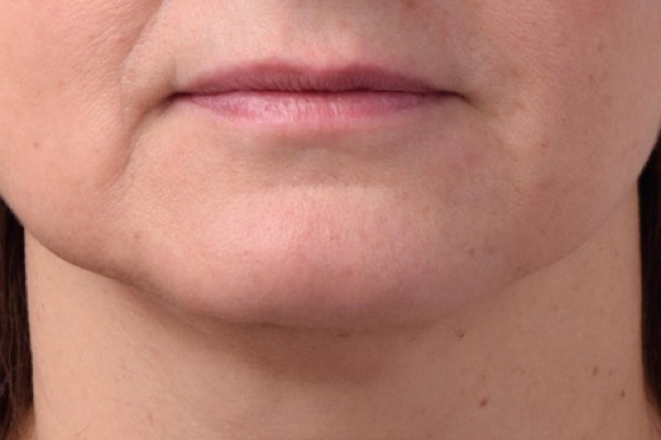 Jaw and chin definition after Exion treatment