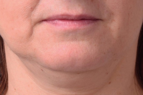 Jaw and chin laxity before Exion treatment