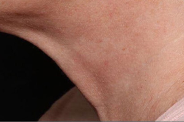 Neck skin tightening after Exion treatment