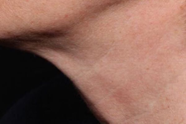 Neck skin laxity before Exion treatment